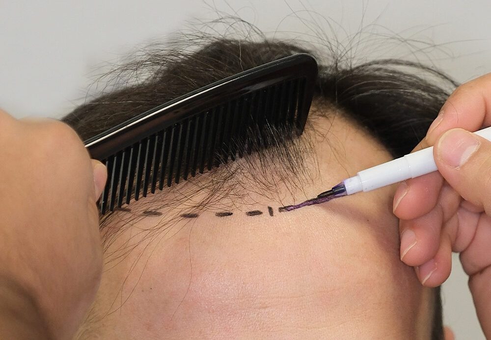A hair transplant moves healthy hair to bald areas for natural growth. It offers a permanent solution to hair loss.