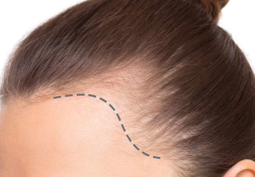 A hair transplant moves healthy hair to bald areas for natural growth. It offers a permanent solution to hair loss.